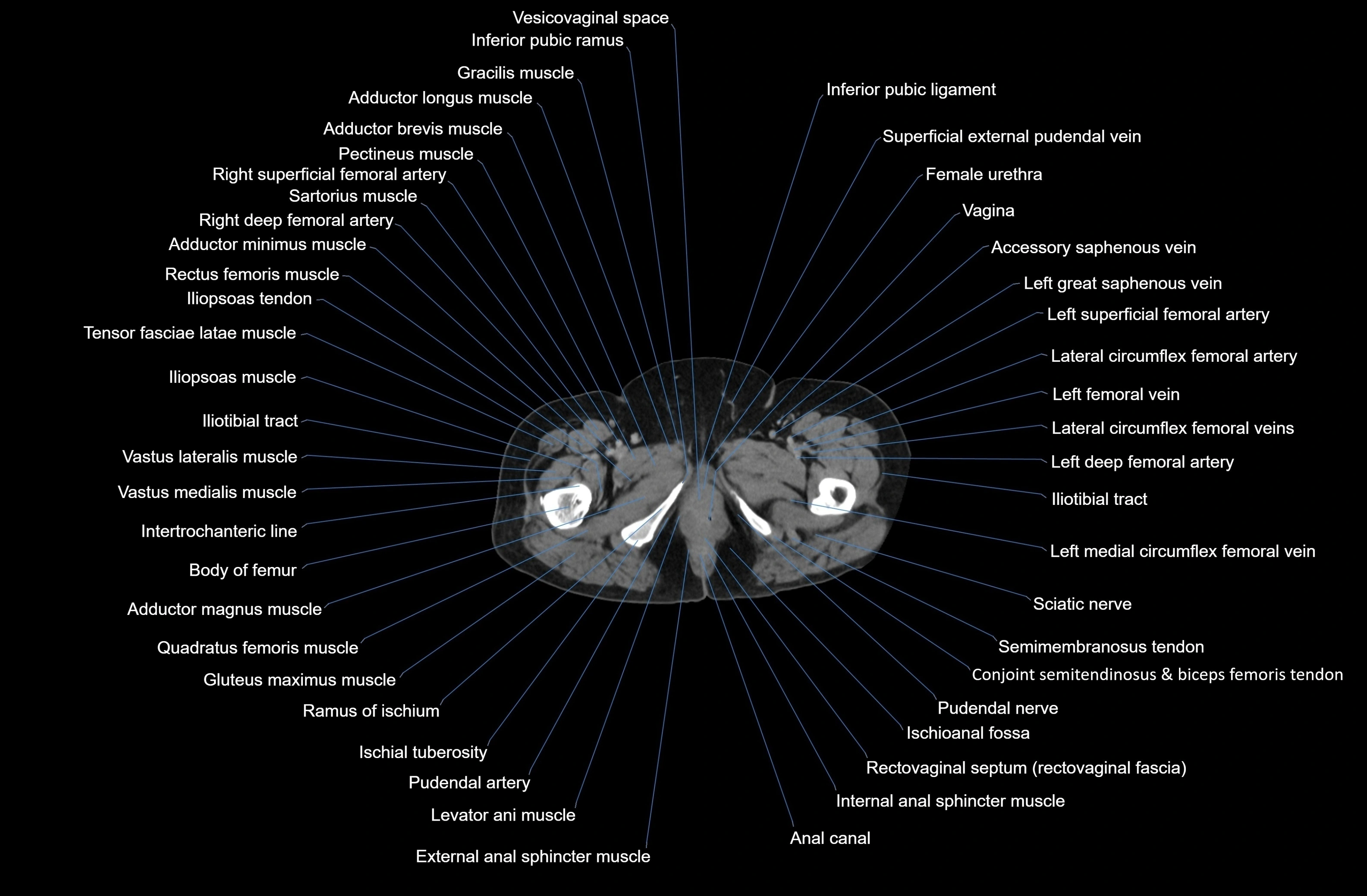 CT Abdomen axial cross sectional anatomy labelled radiology image-00104.webp